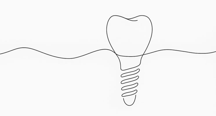 Implant Dentaire Paris