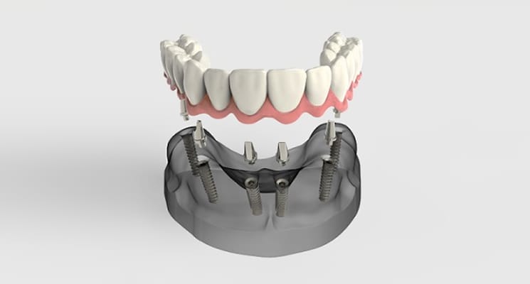 Prothèse dentaire illustration